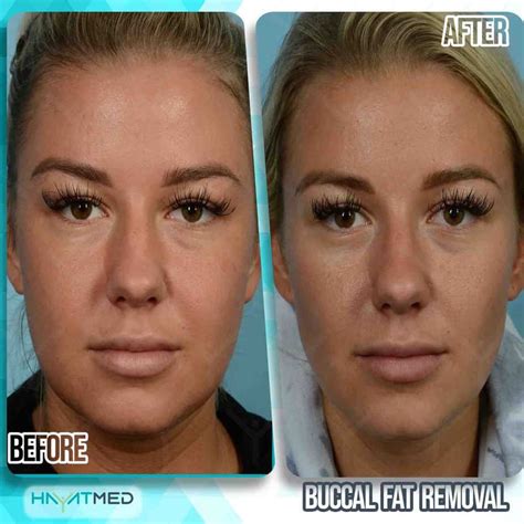 buccal fat removal uk prices